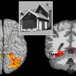 Deep Brain Stimulation Triggers Hallucinations