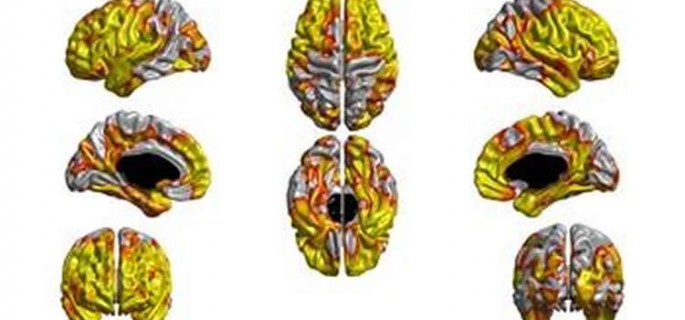 Yellow/orange areas are regions where the thickness of the cortex at age 73 is associated with the amount of lifetime smoking; the greater the amount of lifetime smoking, the thinner the cortex. Image credit: Molecular Psychiatry, S Karama, IJ Deary et al.